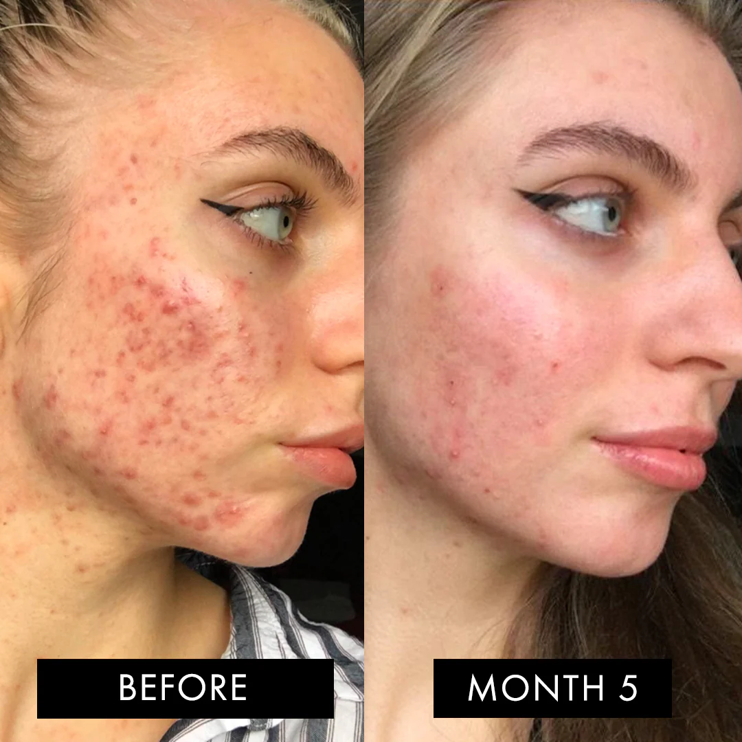 The Skin Elixir Three Month Pack - Image 6